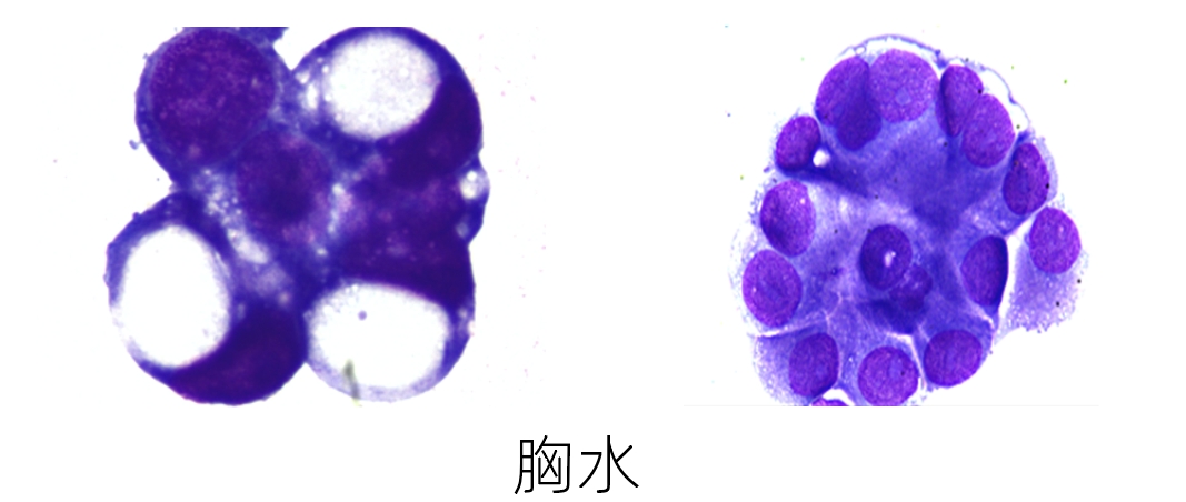 胸水1.png