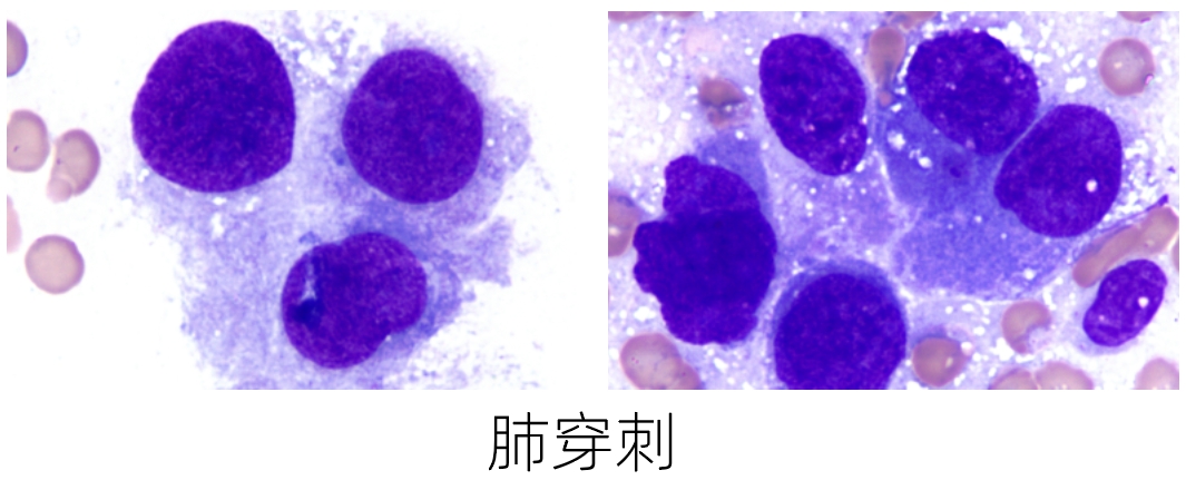 肺穿刺1.png