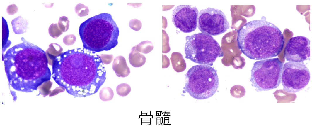 骨髓2.png