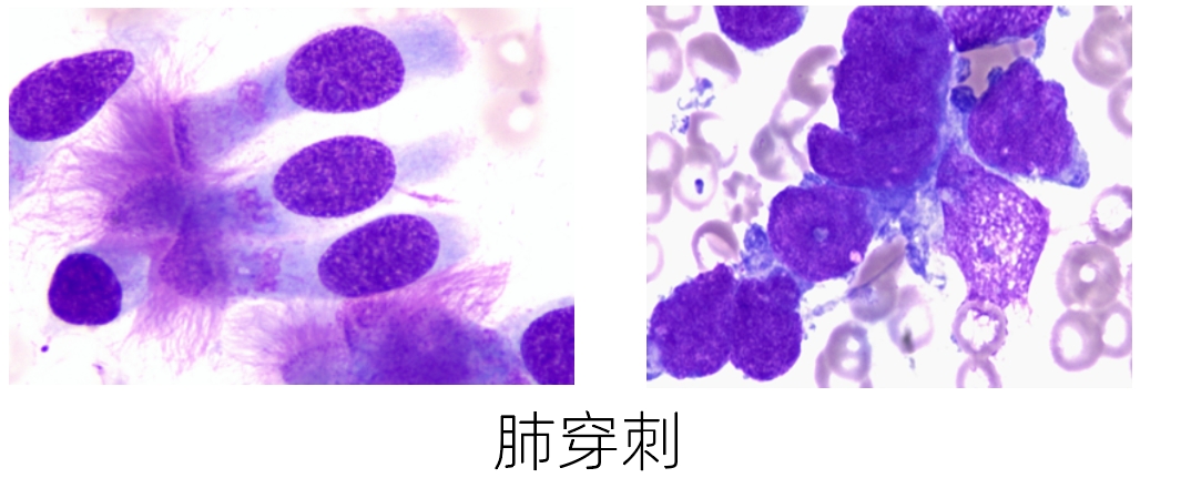 肺穿刺2.png